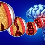 Obat Stroke China Paling Ampuh bagi Pasien Hipertensi Usia 40+