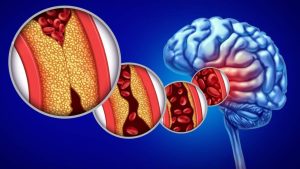 Obat Stroke China Paling Ampuh bagi Pasien Hipertensi Usia 40+ Jangan Tunggu Serangan Datang