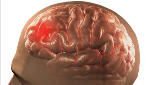 An Gong Niu Huang Wan Original Asli atau Palsu Kesalahan Ini Bisa Berakibat Fatal bagi Pasien Stroke