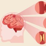 An Gong Niu Huang Wan Original untuk Pasien Stroke Berat – Jangan Biarkan Kondisi Memburuk