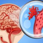 An Gong Niu Huang Wan Original untuk Pemulihan Stroke: Setiap Detik Sangat Berharga