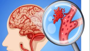 An Gong Niu Huang Wan Original untuk Pemulihan Stroke Setiap Detik Sangat Berharga