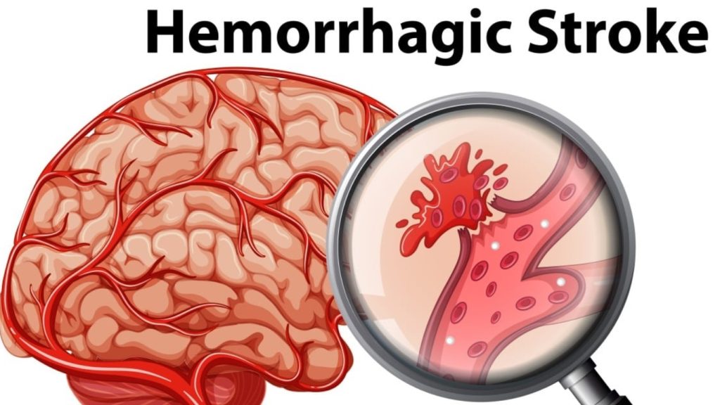 An Gong Niu Huang Wan Original untuk Stroke Hemoragik & Iskemik – Jangan Tunggu Lumpuh Permanen!