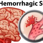 An Gong Niu Huang Wan Original untuk Stroke Hemoragik & Iskemik – Jangan Tunggu Lumpuh Permanen