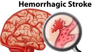 An Gong Niu Huang Wan Original untuk Stroke Hemoragik & Iskemik – Jangan Tunggu Lumpuh Permanen!