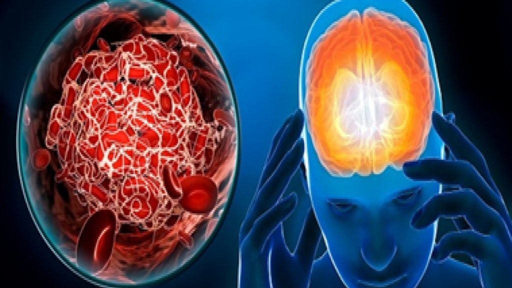 An Gong Niu Huang Wan Original untuk Stroke Mendadak – Sedia Sebelum Serangan Kedua Datang