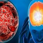 An Gong Niu Huang Wan Original untuk Stroke Mendadak – Sedia Sebelum Serangan Kedua Datang