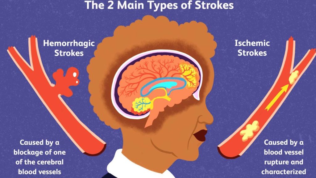 An Gong Niu Huang Wan Original untuk Stroke Sumbatan & Pendarahan – Bertindak Sebelum Terlambat
