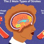 An Gong Niu Huang Wan Original untuk Stroke Sumbatan & Pendarahan – Bertindak Sebelum Terlambat