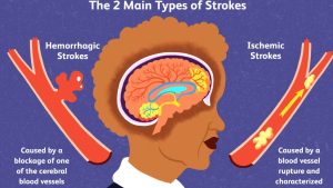 An Gong Niu Huang Wan Original untuk Stroke Sumbatan & Pendarahan – Bertindak Sebelum Terlambat